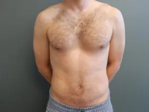 Plastic Surgery Before and After Pictures in Orlando, FL