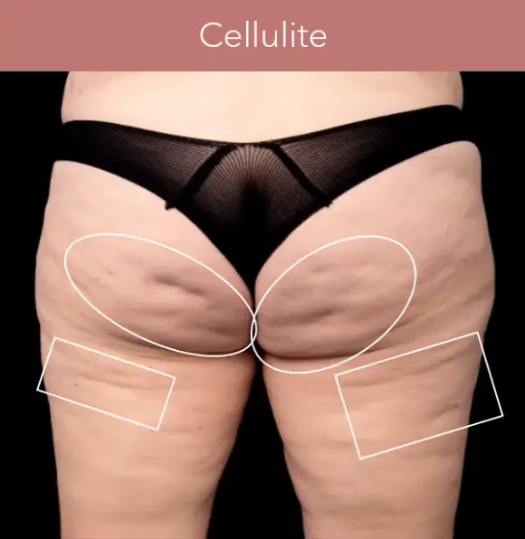 Avéli® in Orlando, FL