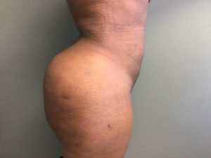 Plastic Surgery Before and After Pictures in Orlando, FL