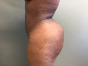 Plastic Surgery Before and After Pictures in Orlando, FL
