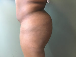 Plastic Surgery Before and After Pictures in Orlando, FL