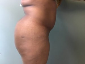 Plastic Surgery Before and After Pictures in Orlando, FL