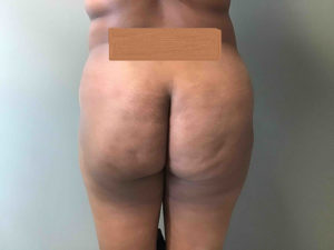 Plastic Surgery Before and After Pictures in Orlando, FL