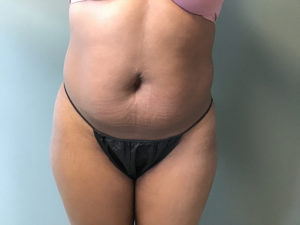 Plastic Surgery Before and After Pictures in Orlando, FL