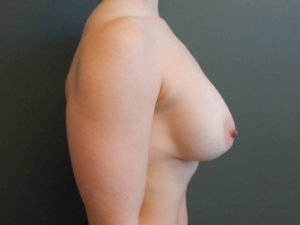 Plastic Surgery Before and After Pictures in Orlando, FL