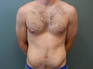 Plastic Surgery Before and After Pictures in Orlando, FL