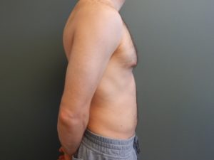 Plastic Surgery Before and After Pictures in Orlando, FL
