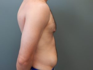Plastic Surgery Before and After Pictures in Orlando, FL