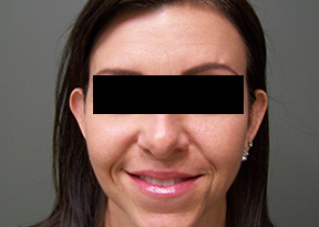 Plastic Surgery Before and After Pictures in Orlando, FL