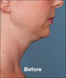 Plastic Surgery Before and After Pictures in Orlando, FL