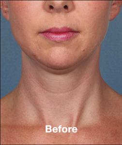 Plastic Surgery Before and After Pictures in Orlando, FL