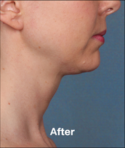 Plastic Surgery Before and After Pictures in Orlando, FL
