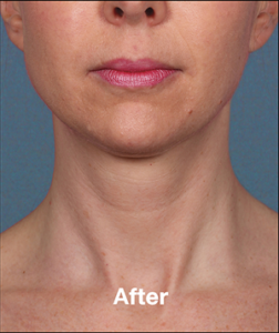 Plastic Surgery Before and After Pictures in Orlando, FL