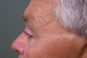 Plastic Surgery Before and After Pictures in Orlando, FL