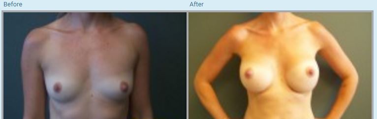 Breast Augmentation Before and After Pictures in Orlando, FL