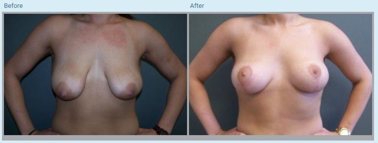 Breast Lift Before and After Pictures in Orlando, FL
