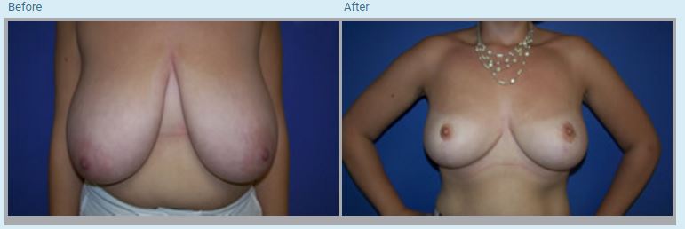 Breast Reduction Before and After Pictures in Orlando, FL
