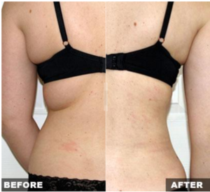 VASER® Lipo in Orlando, FL