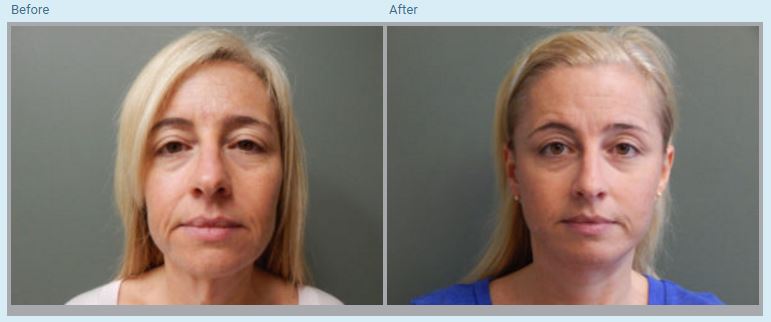 Facelift in Orlando, FL