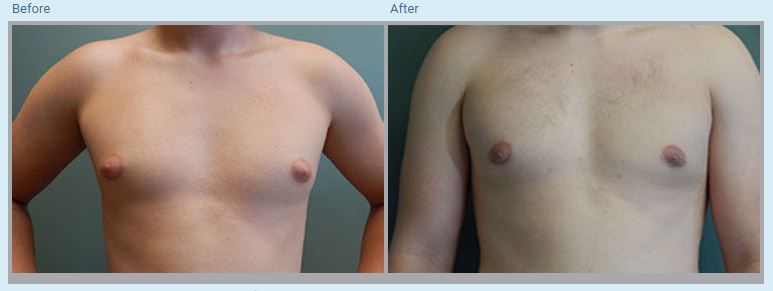 Gynecomastia Before and After Pictures in Orlando, FL