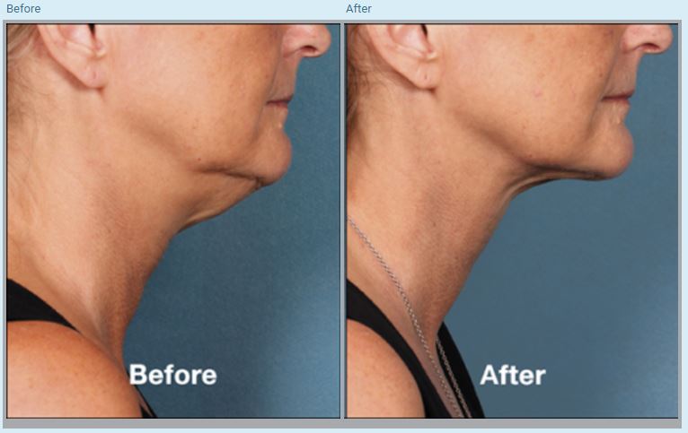 Kybella®Before and After Pictures in Orlando, FL