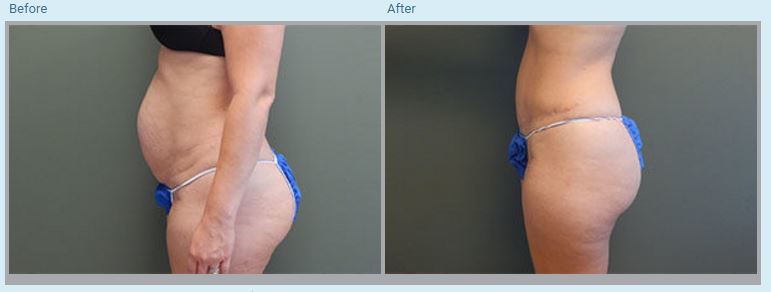 Tummy Tuck, Center for Plastic & Reconstructive Surgery, Dr. Kendall Peters, Orlando, FL