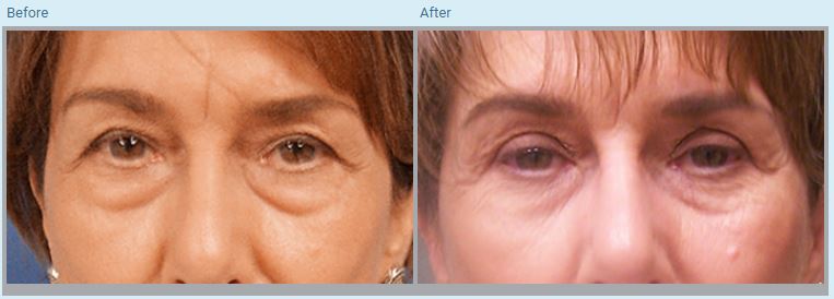 Blepharoplasty Before and After Pictures in Orlando, FL