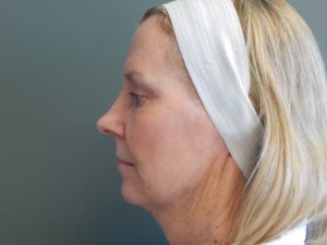 Plastic Surgery Before and After Pictures in Orlando, FL