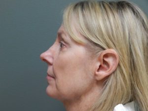 Plastic Surgery Before and After Pictures in Orlando, FL