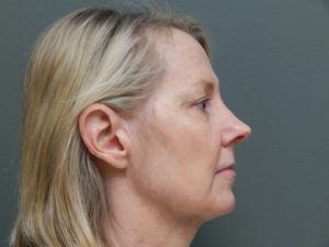 Plastic Surgery Before and After Pictures in Orlando, FL