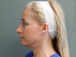 Plastic Surgery Before and After Pictures in Orlando, FL