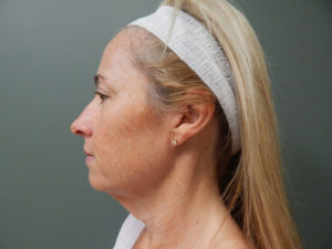 Plastic Surgery Before and After Pictures in Orlando, FL