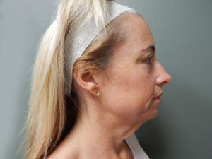 Plastic Surgery Before and After Pictures in Orlando, FL