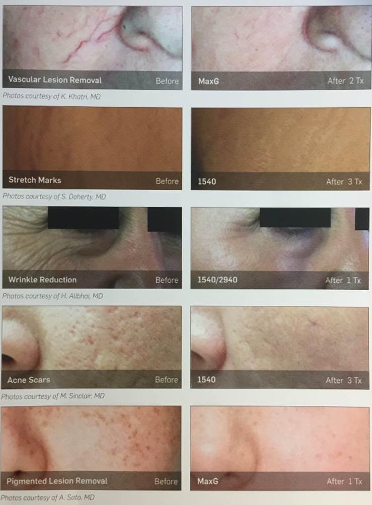 Cynosure® ICON™ Laser in Orlando, FL