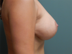 Plastic Surgery Before and After Pictures in Orlando, FL