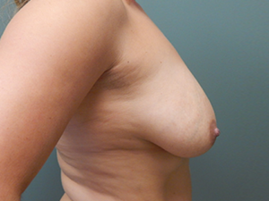 Plastic Surgery Before and After Pictures in Orlando, FL