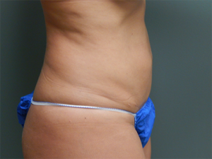 Plastic Surgery Before and After Pictures in Orlando, FL