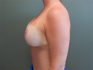 Plastic Surgery Before and After Pictures in Orlando, FL