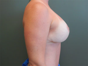 Plastic Surgery Before and After Pictures in Orlando, FL