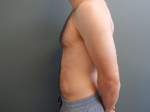 Plastic Surgery Before and After Pictures in Orlando, FL