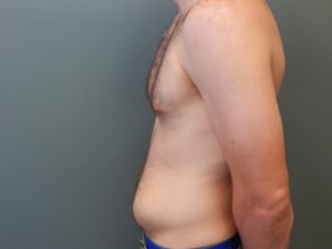 Plastic Surgery Before and After Pictures in Orlando, FL