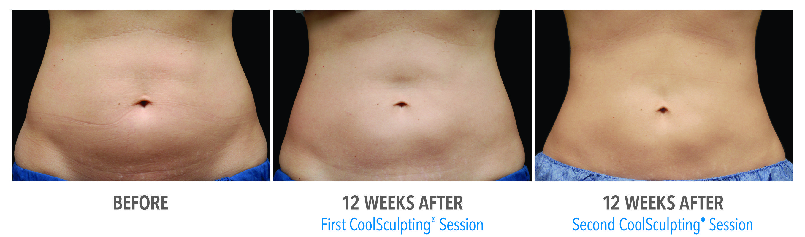 CoolSculpting® in Orlando, FL