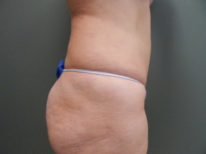 Plastic Surgery Before and After Pictures in Orlando, FL