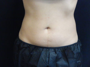 Coolsculpting in Orlando - Price Beat Guarantee