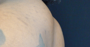 Plastic Surgery Before and After Pictures in Orlando, FL