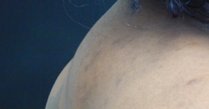 Plastic Surgery Before and After Pictures in Orlando, FL