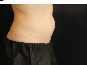 Plastic Surgery Before and After Pictures in Orlando, FL